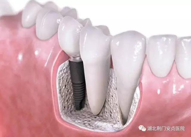 安祯口腔业务学习之 口腔必兰麻详解